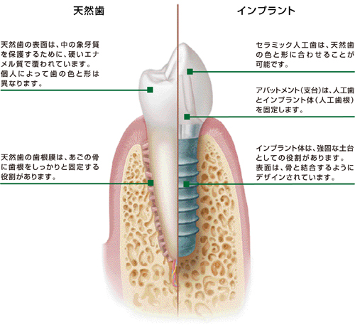 インプラント治療